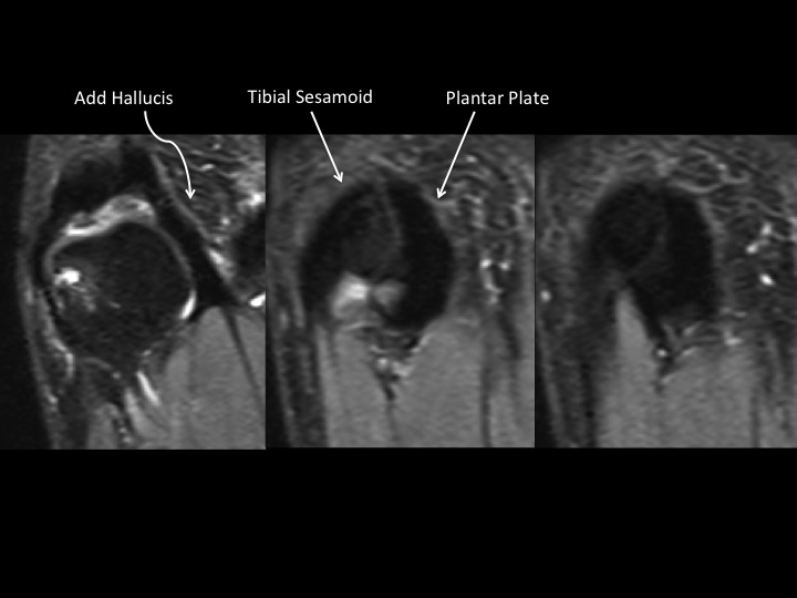 Figure 5 for case fibular sesamoid of metatarsal head ( RID2990 )